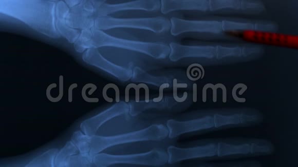 双手骨头的X光片视频的预览图