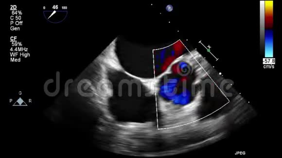 经食管超声检查心脏图像视频的预览图