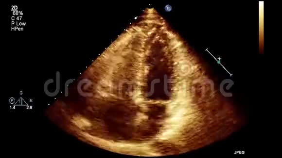 经食管超声检查心脏图像视频的预览图
