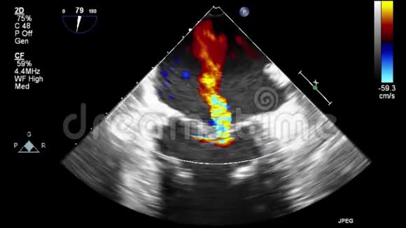 经食管超声检查心脏图像视频的预览图