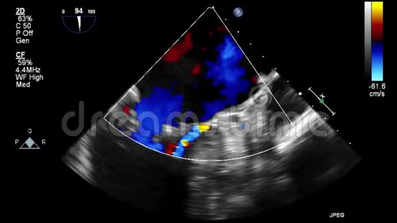 心脏超声经食管检查视频的预览图