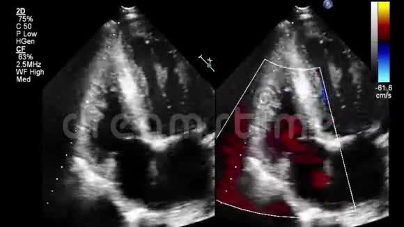 心脏超声经食管检查视频的预览图