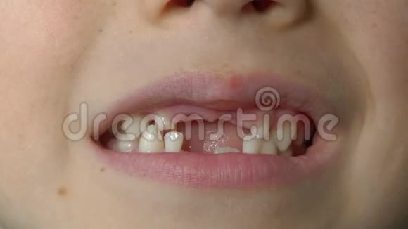 宏观拍摄的一个小男孩显示他的嘴缺奶牙儿童牙齿变化的概念视频的预览图