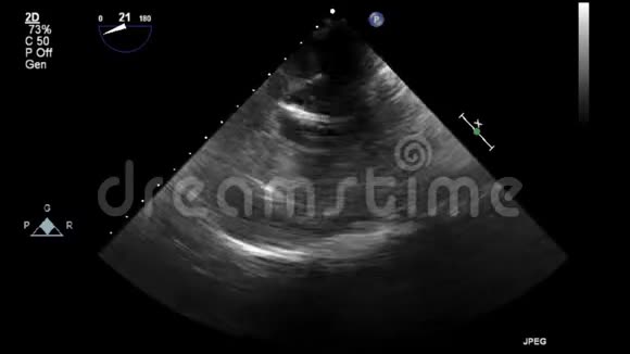 心脏超声经食管检查视频的预览图