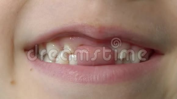 宏观拍摄的一个小男孩显示他的嘴缺奶牙儿童牙齿变化的概念视频的预览图