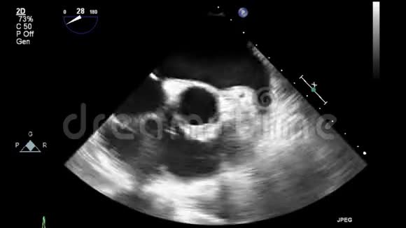 心脏超声经食管检查视频的预览图
