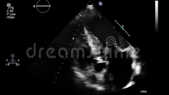 心脏超声经食管检查视频的预览图
