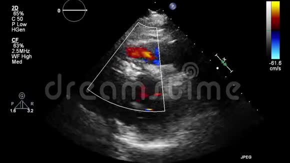 心脏超声经食管检查视频的预览图