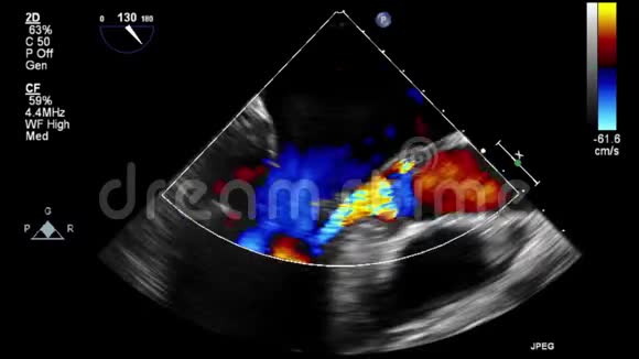 心脏超声经食管检查视频的预览图