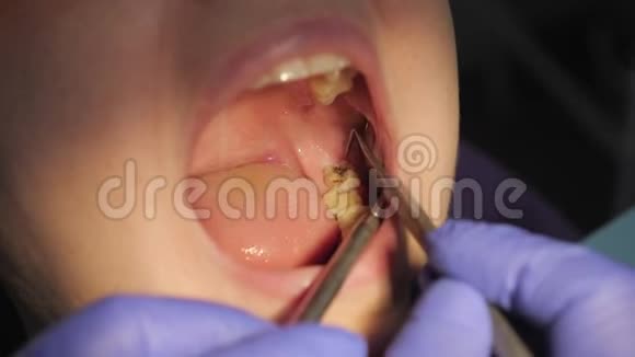牙医使用牙科工具和镜子检查病人有黑色空腔的牙齿蛀牙特写视频的预览图