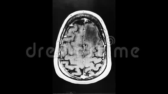 小脑CT扫描呈鸟样视频的预览图