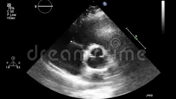 心脏超声经食管检查视频的预览图
