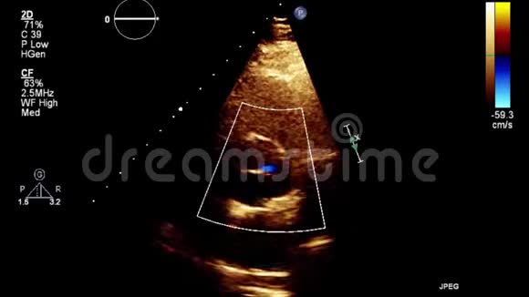 心脏超声经食管检查视频的预览图