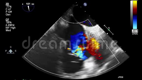 心脏超声经食管检查视频的预览图