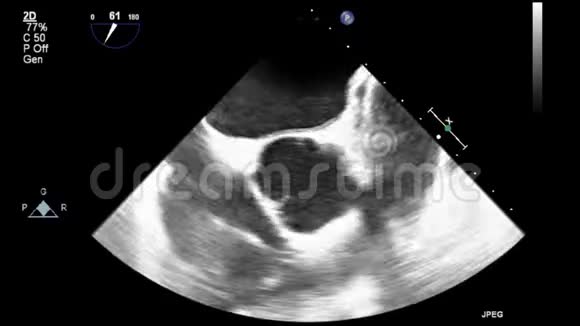 心脏超声经食管检查视频的预览图