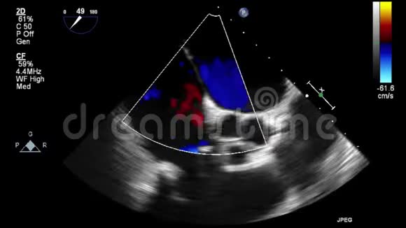 心脏超声经食管检查视频的预览图