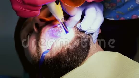 牙科诊所病人的特写牙齿紫外线男子补牙视频的预览图