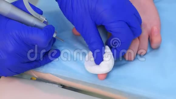 外科手术用激光束去除手指上的疣双手特写视频的预览图
