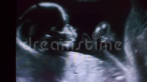 儿童胚胎超声扫描黑白照片视频的预览图