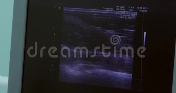 医院超声室监视器屏幕上腿部一部分的图像视频的预览图