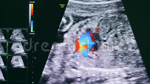 超声波检查子宫里的婴儿视频的预览图