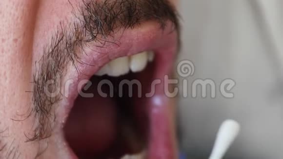 口腔咽拭子治疗呼吸道病毒视频的预览图