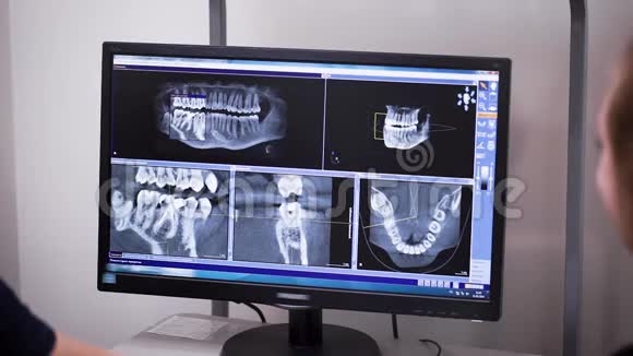 牙医和正畸医生正在监视器上查看病人的牙齿和颌骨的x光片从后面看视频的预览图