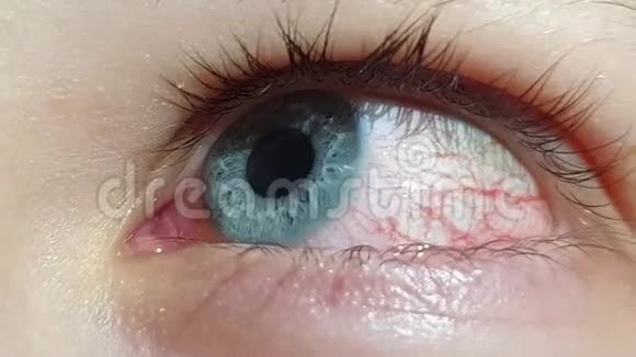 病眼特写眼睛红肿血管结膜炎视频的预览图