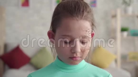 一个悲伤的疲惫的女孩的肖像有缺陷或烧伤的脸看着相机视频的预览图