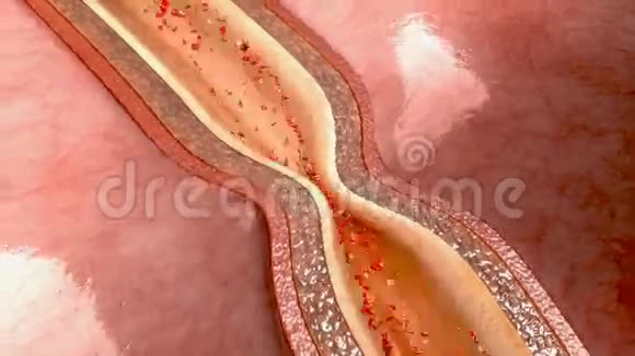 动脉痉挛视频的预览图
