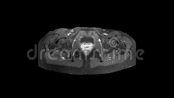 人体骨盆和臀部MRI扫描视频的预览图