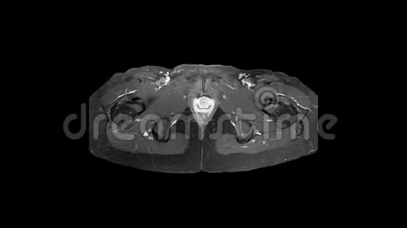 人骨盆及髋部MRI扫描视频的预览图
