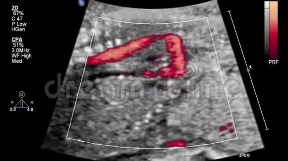 胎心超声检查视频的预览图