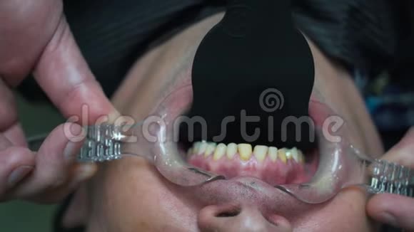 病人手术下的牙齿特写视频的预览图