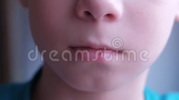童童触及唇部疱疹疮口口腔特写视频的预览图