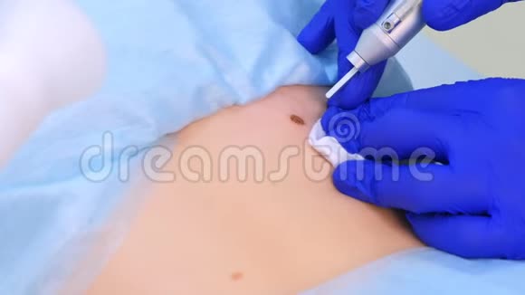医生外科医生用激光清除病人背部的痣特写视频的预览图