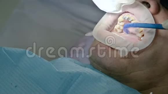 在修复术中从牙科医生病人口中近距离吸入液体视频的预览图