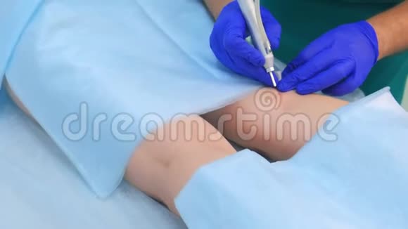 医生外科医生用激光在病人腿上移除胎记双手特写视频的预览图
