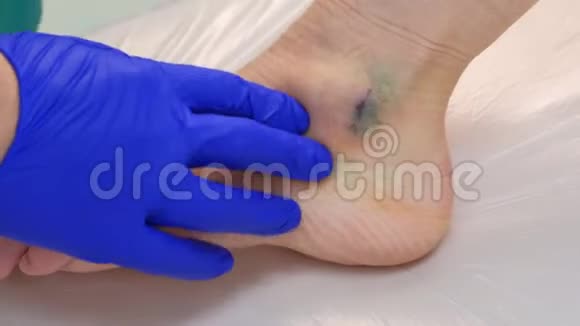 外科医生在手术后触诊腿部周围缝合以去除脚踝湿瘤视频的预览图
