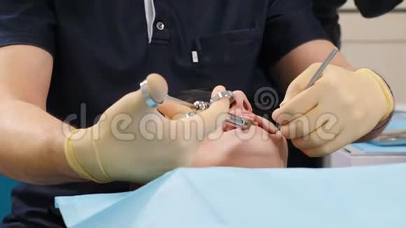 牙医给牙龈注射局部麻醉剂男性牙医做牙科麻醉没有疼痛的概念医学和医学视频的预览图