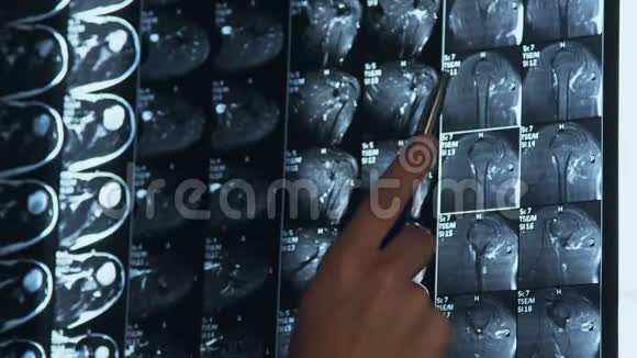 医生检查MRI肩关节扫描视频的预览图