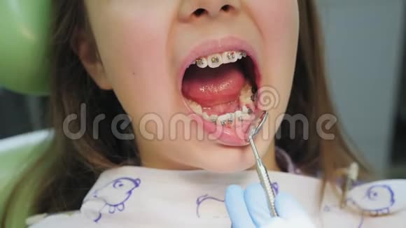 一个戴牙套的女孩牙齿的特写镜头检查视频的预览图