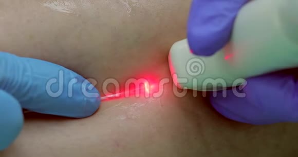 医生用激光引导传感器在超声过程中沿膝盖表面移动视频的预览图