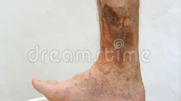 人类皮肤病受皮肤病影响的足部有疤痕溃疡和色素斑视频的预览图