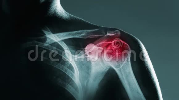 人肩关节在x射线中视频的预览图