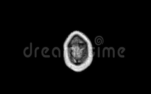 脑CTMRI扫描视频的预览图