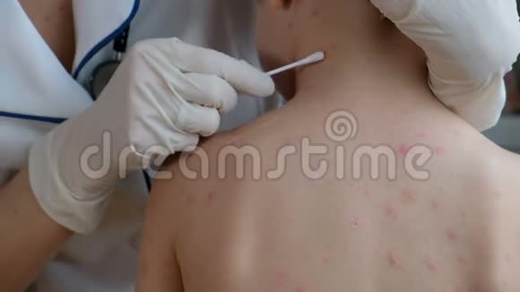 医生在婴儿的皮肤上涂奶油以预防水痘及皮疹视频的预览图