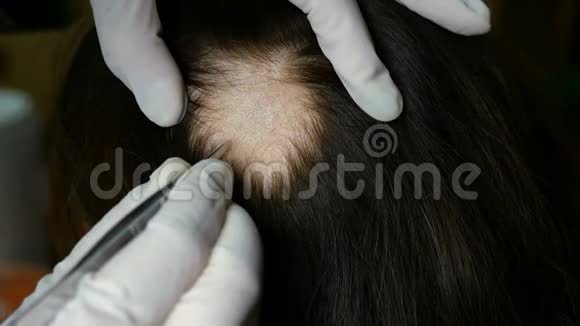 女人脱发医生或美容师做检查做手术头部的女人皮肤上没有头发视频的预览图