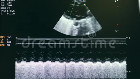 婴儿心脏的超声筛查视频的预览图