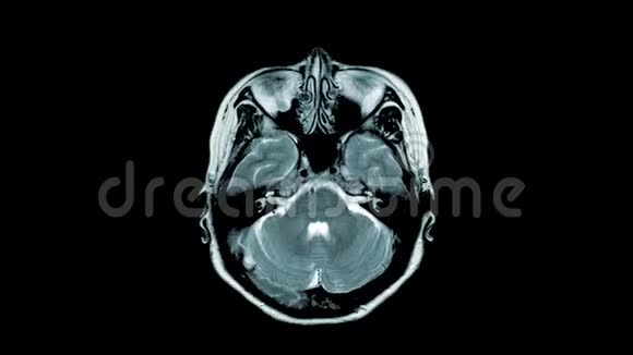 脑磁共振血管造影视频的预览图